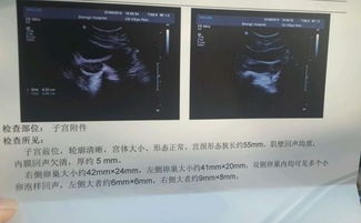 卵泡破裂就是排卵日吗