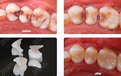 复合树脂补牙好不好