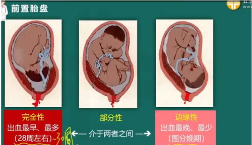 胎盘早剥算难产吗?