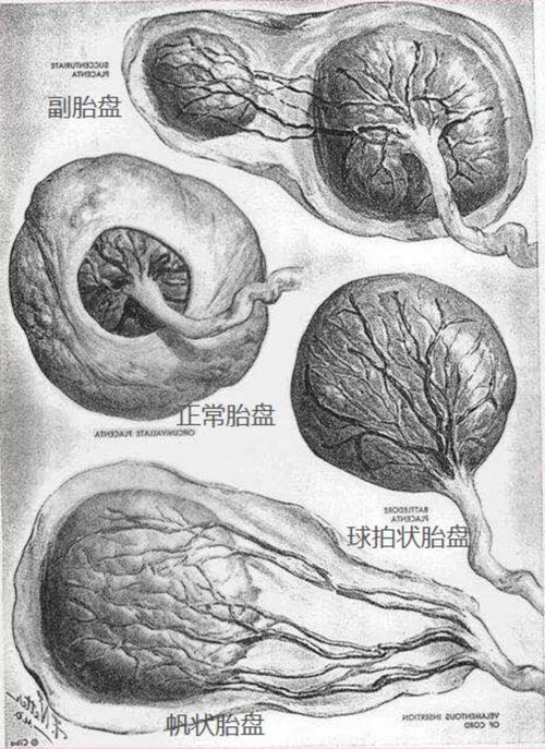 帆状胎盘是什么意思图片