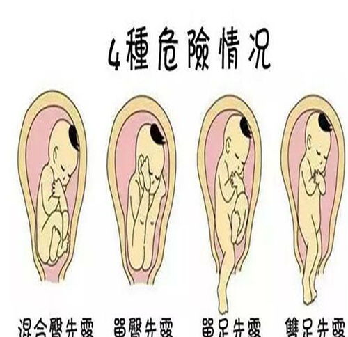 怀孕36周，臀位。请问还有可能转为头位吗？