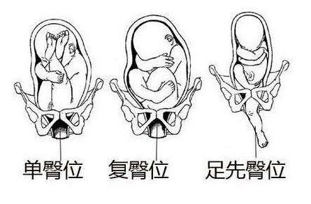 怀孕36周，臀位。请问还有可能转为头位吗？