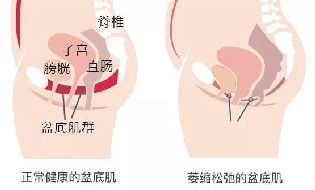 自己在家怎么做盆底康复训练