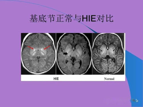 新生儿缺氧缺血性脑病的治疗方法中除外