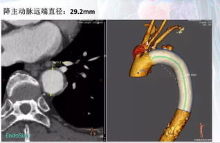 心肚三维成像cta检查心脏,多长时间能哺乳