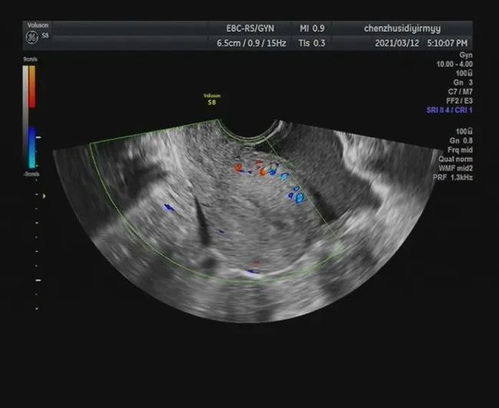 右侧卵巢内可见一大小约18X16mm的无回声区,边界清,内透声佳