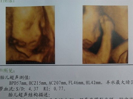 如何通过四维彩超图片看宝宝长相