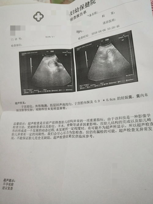 怀孕五十五天孕囊25mmx14mm椭圆形是男孩还是女孩