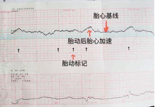 胎心率怎么突然下降了