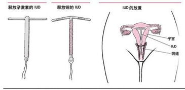 放避孕环对身体有害吗