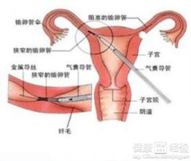 输卵管堵塞不手术吃药能治好吗