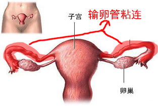 输卵管积水怎么治疗可以怀孕