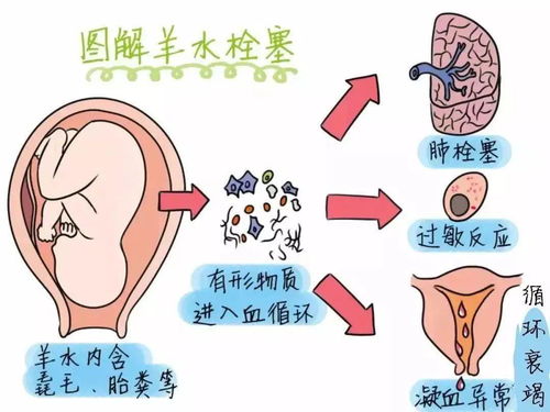 关于羊水早破的原因和危害问题分析