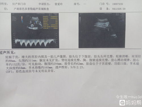 双肾盂轻度分离，大家猜猜是男孩还是女孩