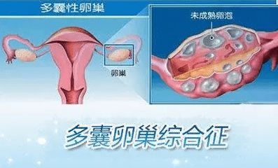 卵巢多囊的治疗方法有哪些