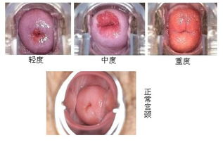 宫颈糜烂严重怀孕了有影响吗