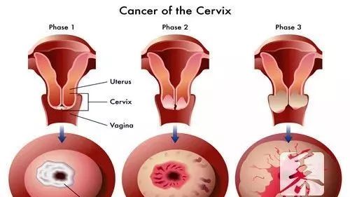宫颈糜烂严重怀孕了有影响吗