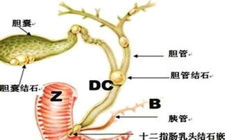 胆结石不做手术能治好吗