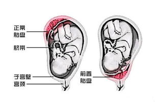 前置胎盘有宫缩怎么办