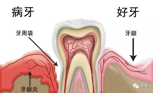 孕期喜酸一定是男孩吗