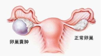 宫腔内多发性囊肿怎么办