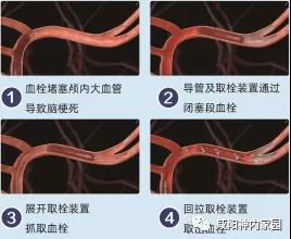 小孩打生长激 素对骨龄有要求吗？