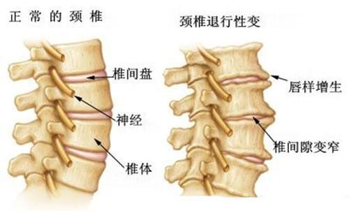 颈复康颗粒治颈椎病效果怎样？