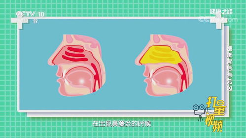 性鼻窦炎发作时可以用生理盐水加入抗生素洗鼻吗