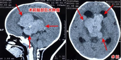 3岁小孩下眼皮里面长了个豆豆，外面看起来有点肿。