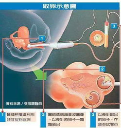 取卵手术费用大概多少