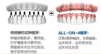 请戴活动假牙的先生女士说说感觉和注意事项