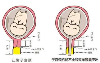 宫颈环扎术保胎成功率多少