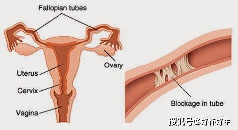 导致输卵管堵塞的原因是什么?