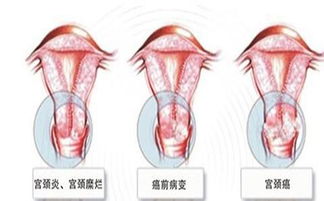 白带像水样是什么原因