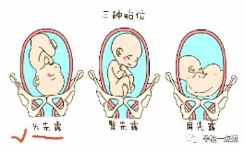 怀孕36周胎儿臀位可以顺产吗