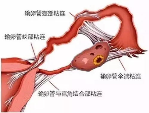 输卵管粘连怎么治最快