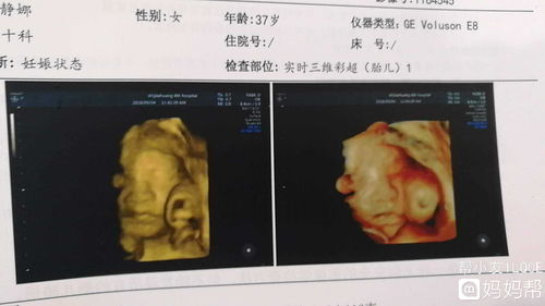 怀孕14周做的彩超内容帮忙看看！