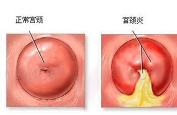 宫颈糜烂会导致不孕不育吗