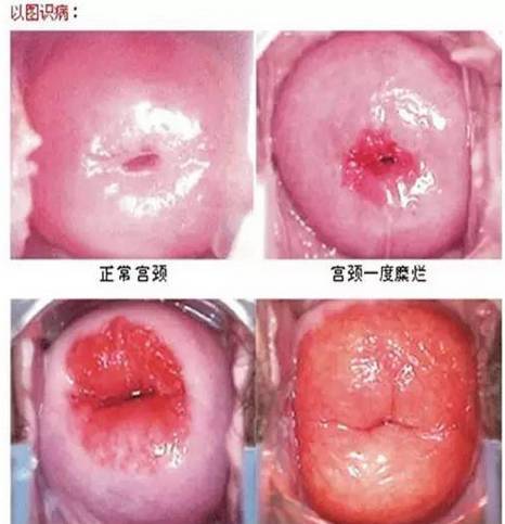 宫颈糜烂会导致不孕不育吗