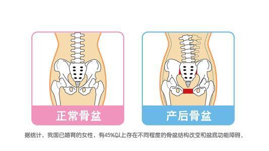 产后骨盆前倾怎么办