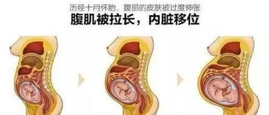 产后骨盆前倾怎么办