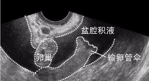 怀孕宫腔积液怎么办