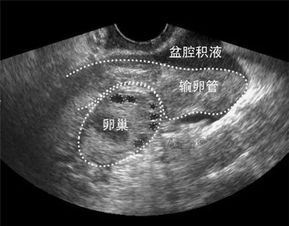 怀孕宫腔积液怎么办