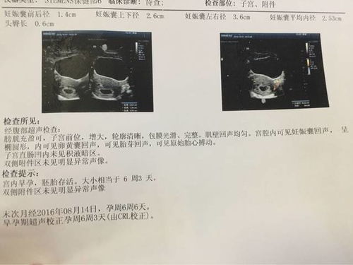 根据孕囊形状预测胎儿性别准吗？