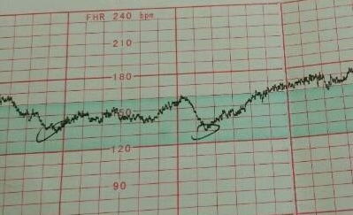 怀孕12周胎心率正常值