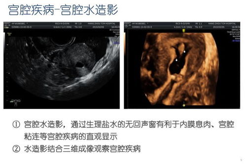 尖锐湿疣会导致不孕吗