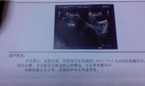 怀孕53天，有胎芽7.3mm，见心管搏动，但卵黄囊不规则3.2*1.2mm。这样容易流产吗