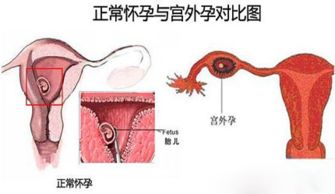 带环怀孕能摘环吗