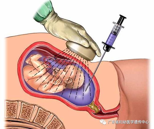 羊水深度标准与孕周的关系是什么