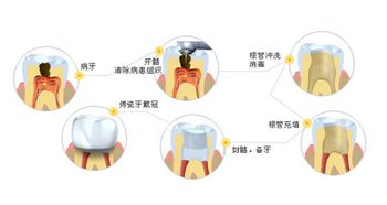 种植牙的步骤？？？